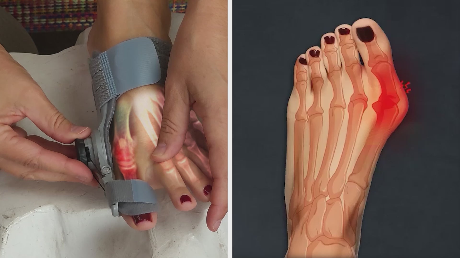 Bunion Fix Foot Tool